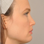 Kybella Delaware | Premier Cosmetic Surgery DE