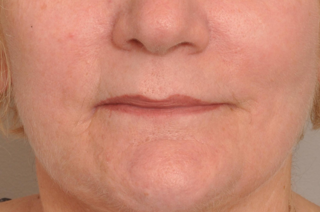 Lip Augmentation Delaware | Premier Cosmetic Surgery DE