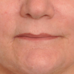 Lip Augmentation Delaware | Premier Cosmetic Surgery DE