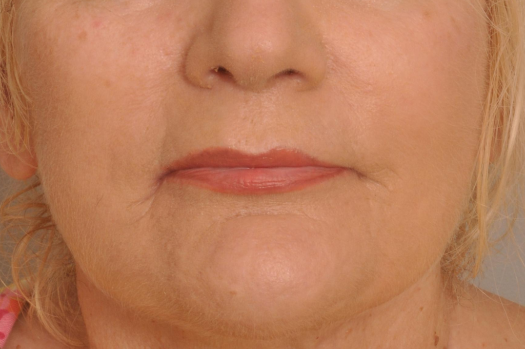 Lip Augmentation Delaware | Premier Cosmetic Surgery DE