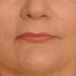 Lip Augmentation Delaware | Premier Cosmetic Surgery DE