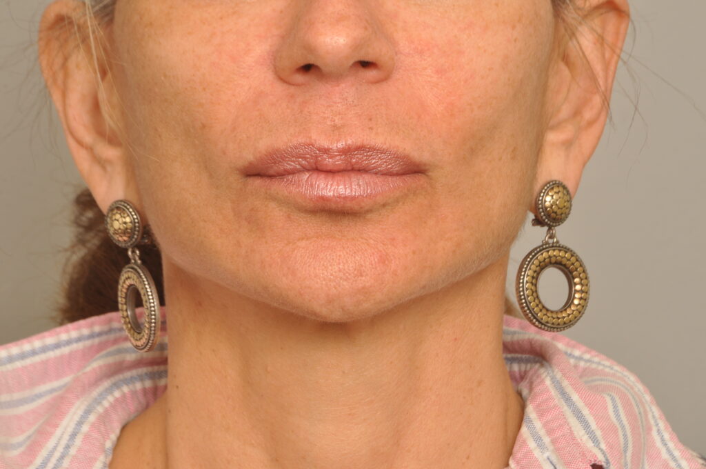 Lip Augmentation Delaware | Premier Cosmetic Surgery DE