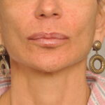 Lip Augmentation Delaware | Premier Cosmetic Surgery DE