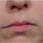 Lip Augmentation Delaware | Premier Cosmetic Surgery DE