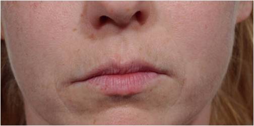 Lip Augmentation Delaware | Premier Cosmetic Surgery DE