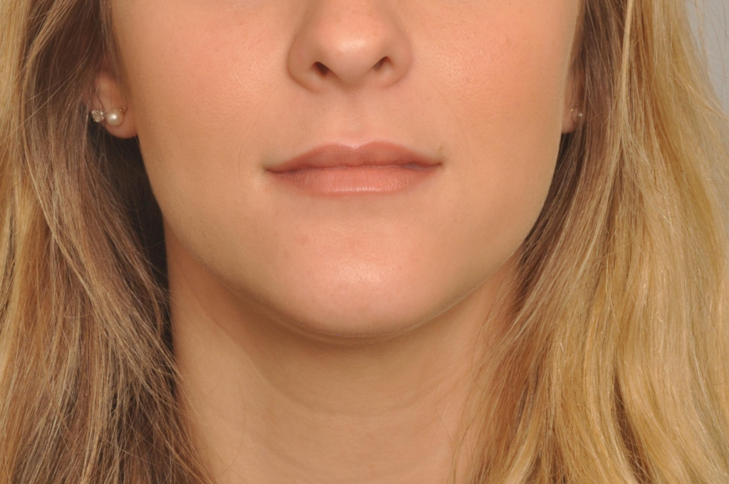 Lip Fillers Delaware | Premier Cosmetic Surgery DE