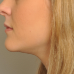 Lip Fillers Delaware | Premier Cosmetic Surgery DE