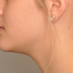 Lip Fillers Delaware | Premier Cosmetic Surgery DE