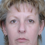 Mid Face Lift Delaware | Premier Cosmetic Surgery DE