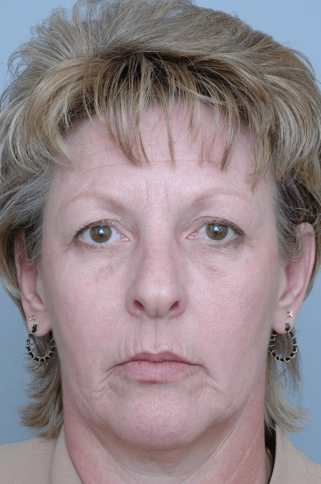 Mid Face Lift Delaware | Premier Cosmetic Surgery DE