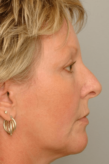 Mid Face Lift Delaware | Premier Cosmetic Surgery DE