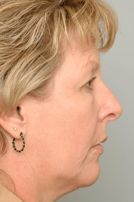 Mid Face Lift Delaware | Premier Cosmetic Surgery DE