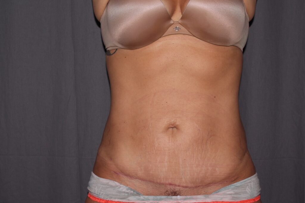 Mini Tummy Tuck Delaware | Premier Cosmetic Surgery DE