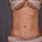 Mini Tummy Tuck Delaware | Premier Cosmetic Surgery DE