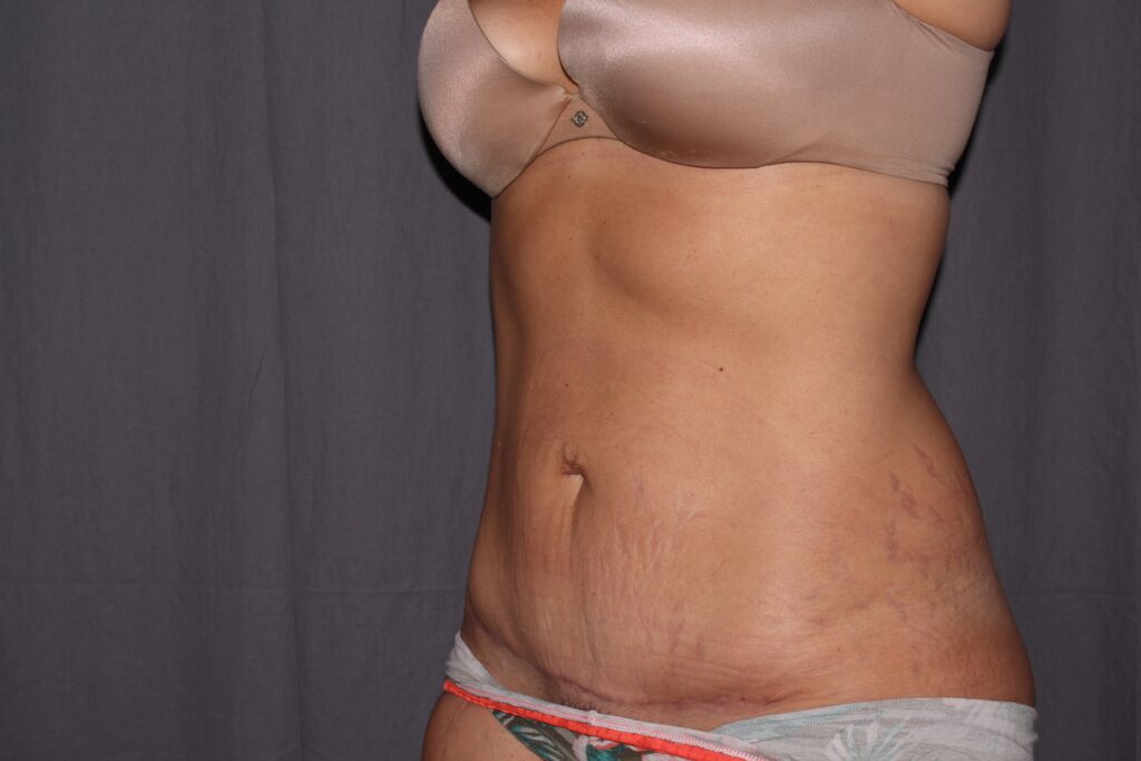 Mini Tummy Tuck Delaware | Premier Cosmetic Surgery DE