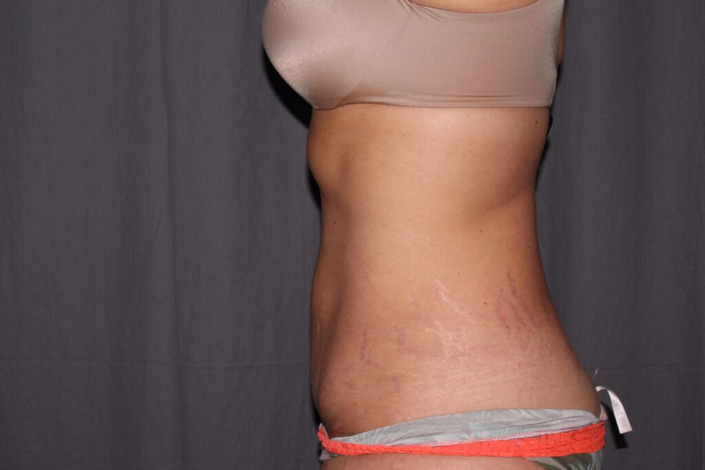 Mini Tummy Tuck Delaware | Premier Cosmetic Surgery DE