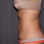 Mini Tummy Tuck Delaware | Premier Cosmetic Surgery DE