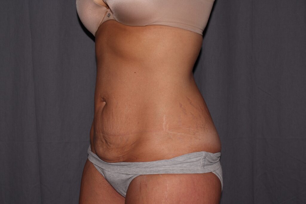 Mini Tummy Tuck Delaware | Premier Cosmetic Surgery DE