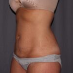 Mini Tummy Tuck Delaware | Premier Cosmetic Surgery DE