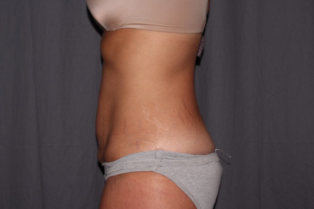 Mini Tummy Tuck Delaware | Premier Cosmetic Surgery DE