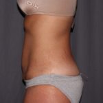 Mini Tummy Tuck Delaware | Premier Cosmetic Surgery DE