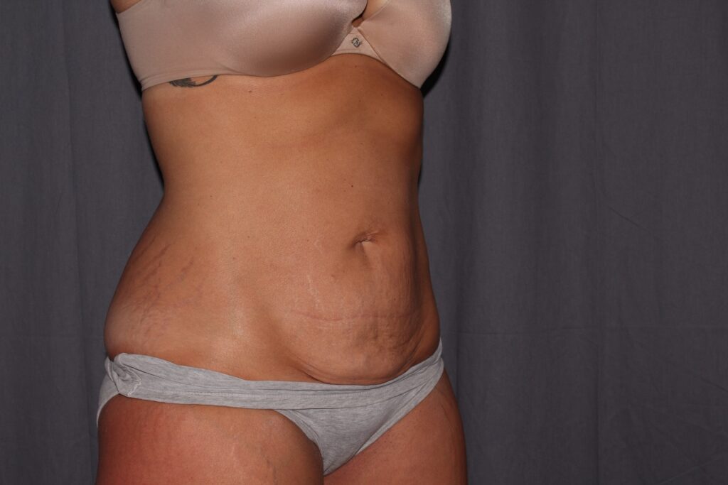 Mini Tummy Tuck Delaware | Premier Cosmetic Surgery DE