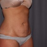 Mini Tummy Tuck Delaware | Premier Cosmetic Surgery DE