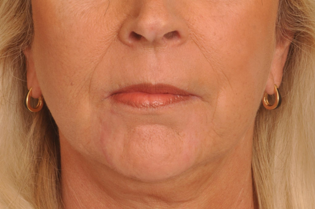 Phenol Peel | Premier Cosmetic Surgery DE