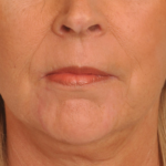 Phenol Peel | Premier Cosmetic Surgery DE