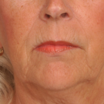 Phenol Peel | Premier Cosmetic Surgery DE