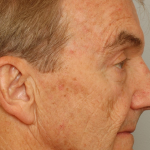 Ptosis Repair Delaware | Premier Cosmetic Surgery DE