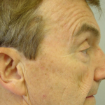 Ptosis Repair Delaware | Premier Cosmetic Surgery DE