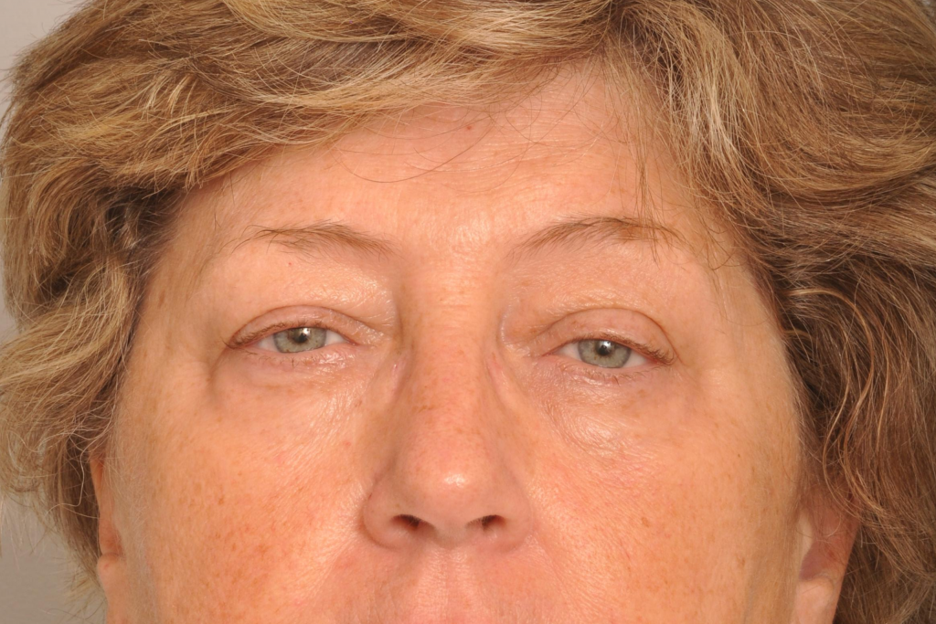 Ptosis Repair Delaware | Premier Cosmetic Surgery DE