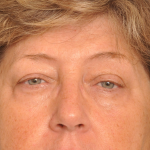 Ptosis Repair Delaware | Premier Cosmetic Surgery DE