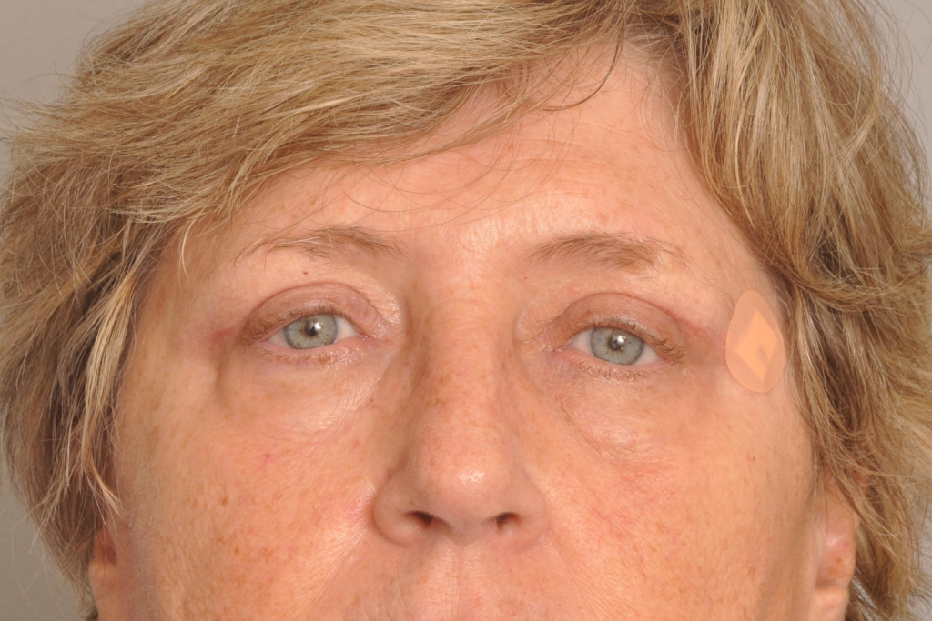 Ptosis Repair Delaware | Premier Cosmetic Surgery DE