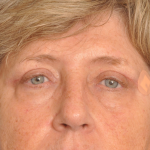 Ptosis Repair Delaware | Premier Cosmetic Surgery DE