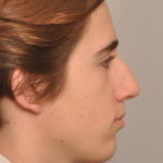 Rhinoplasty Delaware | Premier Cosmetic Surgery DE