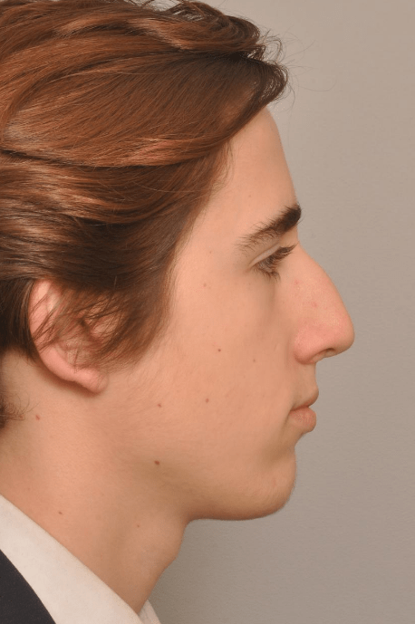 Rhinoplasty Delaware | Premier Cosmetic Surgery DE