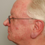 Rhinophyma Delaware | Premier Cosmetic Surgery DE