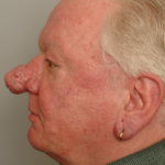 Rhinophyma Delaware | Premier Cosmetic Surgery DE