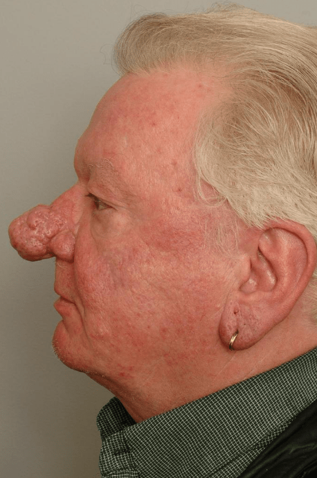 Rhinophyma Delaware | Premier Cosmetic Surgery DE
