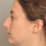 Rhinoplasty Delaware | Premier Cosmetic Surgery DE