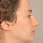 Rhinoplasty Delaware | Premier Cosmetic Surgery DE