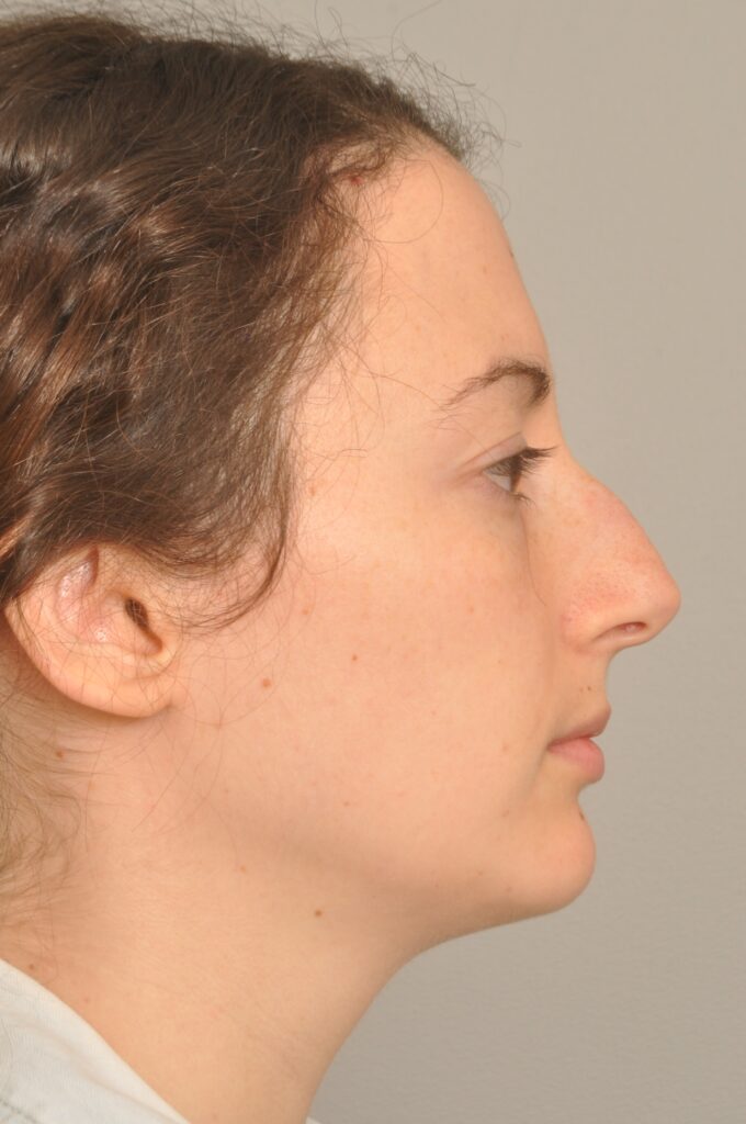 Rhinoplasty Delaware | Premier Cosmetic Surgery DE