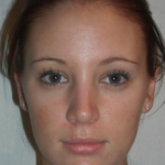 Rhinoplasty Delaware | Premier Cosmetic Surgery DE