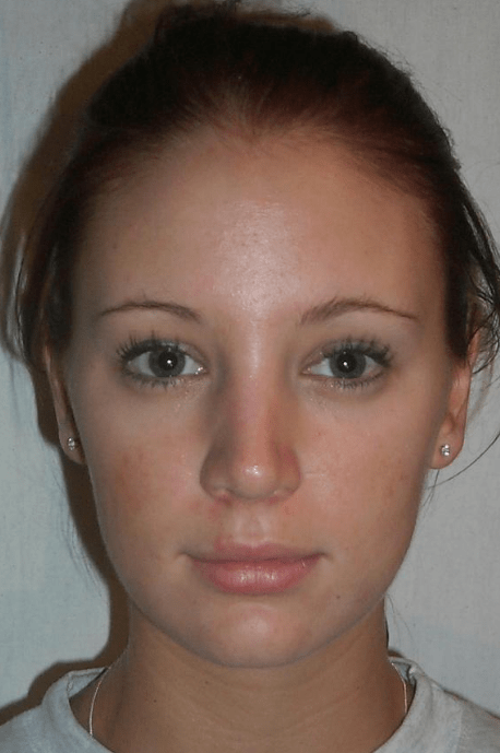 Rhinoplasty Delaware | Premier Cosmetic Surgery DE