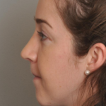 Rhinoplasty Delaware | Premier Cosmetic Surgery DE