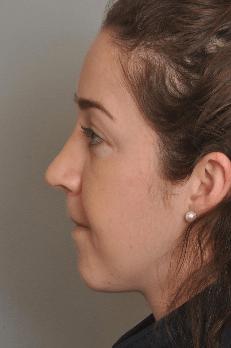 Rhinoplasty Delaware | Premier Cosmetic Surgery DE