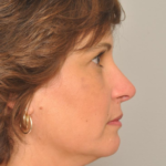 Rhinoplasty Delaware | Premier Cosmetic Surgery DE