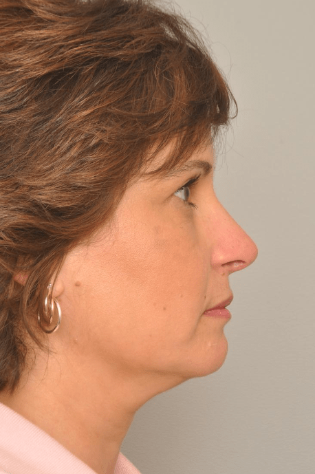 Rhinoplasty Delaware | Premier Cosmetic Surgery DE